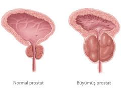 Prostat kanseri teşhisinde yeni dönem